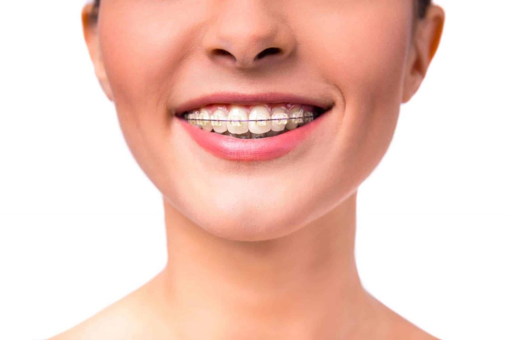 görünmez diş teli tedavisi