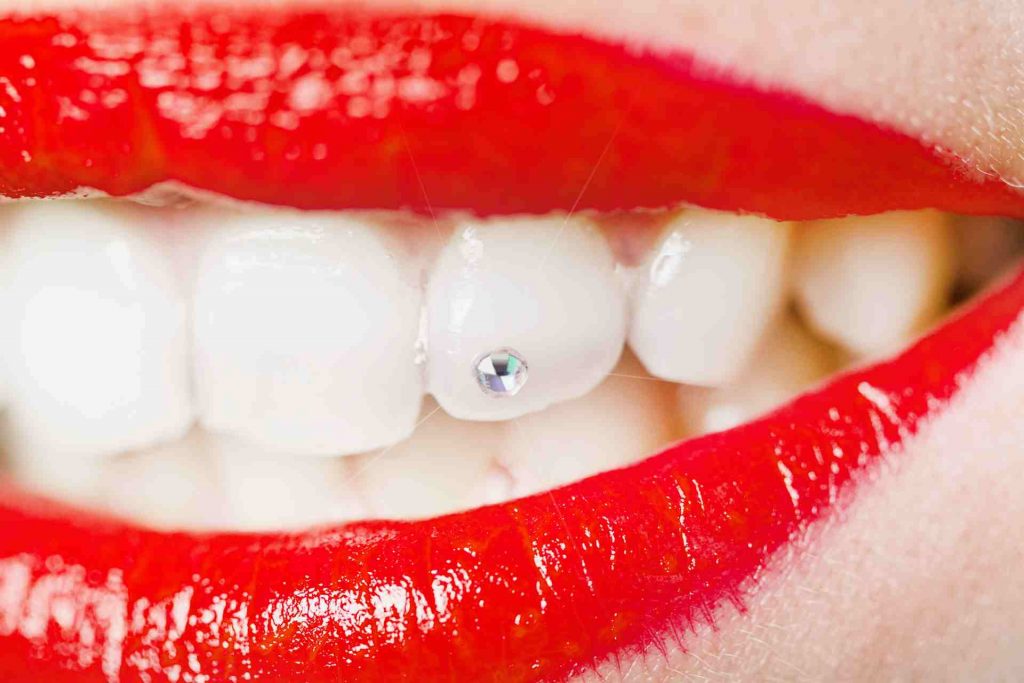 diş kristali nasıl takılır