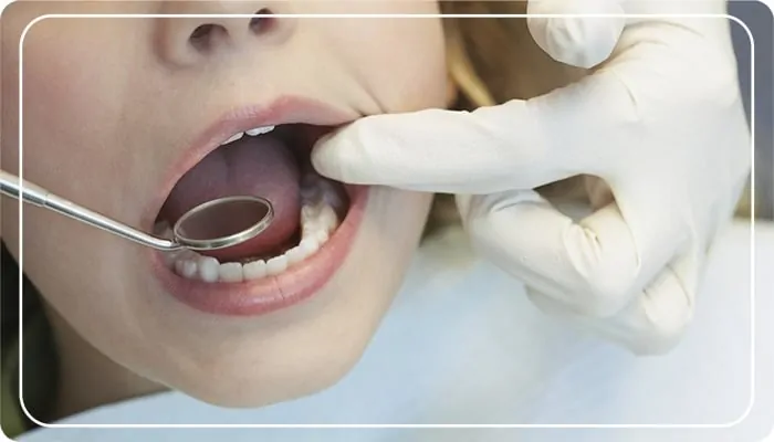 yirmilik diş çekimi sonrası iyileşme süreci